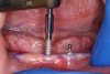 Fig 6. The implant can also be advanced with a surgical handpiece and adapter.
