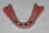 Fig 12. Intaglio surface of mandibular processed denture base with reinforced metal framework and attachments; teeth were set in wax.