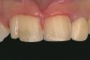 Fig 11. Fused teeth Nos. 7 and 8 and tooth
No. 9 were prepared for veneers.