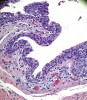 Fig 5. View of duct wall showing a thickened layer of epithelium displaying features
of an unorganized squamous epithelium and polarized cells consistent with short columnar epithelium (hematoxylin and eosin stain; original magnification of 200x).