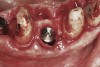 Fig 4. Clinical view of an implant placed into an immediate extraction socket at site No. 28. A n insertion torque of <10 Ncm resulted in a spinner.