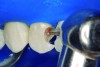 Fig 5. Partial pulpotomy with No. 1012 diamond bur under water cooling.