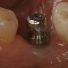 Fig 2. An example of a titanium carrier fixture with a large 360° undercut that was modified for sufficient occlusal and interproximal clearance.