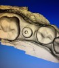 Fig 5. The scanned image of the abutment with the clearly defined screw-access hole.