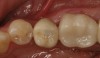 Fig 21. Occlusal view of the screw-retained implant crown.