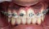 Fig 8. Preoperative view (Fig 8) of a patient who underwent localized gingival recontouring of the maxillary left central and lateral incisors; and just after gingivectomy (Fig 9).