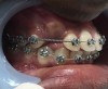 Fig 10. A male patient with a buccally impacted maxillary right canine (Fig 10) is shown right after laser exposure (Fig 11), at 24 hours post-treatment (Fig 12), and after nearly 6 weeks’ follow-up (Fig 13).