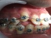 Fig 13. A male patient with a buccally impacted maxillary right canine (Fig 10) is shown right after laser exposure (Fig 11), at 24 hours post-treatment (Fig 12), and after nearly 6 weeks’ follow-up (Fig 13).