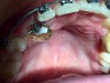 Fig 15. Male patient with a palatally impacted maxillary right canine (Fig 14) is shown right after palatal laser exposure (Fig 15), a relatively dry field that facilitates orthodontic bonding procedure, at 2 weeks post-treatment (Fig 16), and after 4 months’ follow-up following the change of bracket (Fig 17).