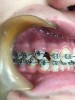 Fig 17. Male patient with a palatally impacted maxillary right canine (Fig 14) is shown right after palatal laser exposure (Fig 15), a relatively dry field that facilitates orthodontic bonding procedure, at 2 weeks post-treatment (Fig 16), and after 4 months’ follow-up following the change of bracket (Fig 17).