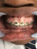 Fig 1. A female patient with gingival hyperplasia in the esthetic zone after removal of orthodontic wire; the enlargement of the interdental pailla is evident (Fig 1), following gingivectomy (Fig 2), after cleaning the carbonized tissue with 3% hydrogen peroxide (Fig 3), and 2 months following the debond process (Fig 4).