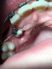 Fig 16. Male patient with a palatally impacted maxillary right canine (Fig 14) is shown right after palatal laser exposure (Fig 15), a relatively dry field that facilitates orthodontic bonding procedure, at 2 weeks post-treatment (Fig 16), and after 4 months’ follow-up following the change of bracket (Fig 17).