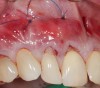 Fig 8. Apical periosteal suture below the mucogingival junction will “lift” the APRF/flap complex coronally. This intimate proximity of the APRF membranes with the periodontal ligaments will allow for a slow release of growth factors, thus promote keratinization.