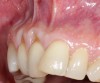 Fig 10. Cross-sectional view of the preoperative and postoperative (2 years). A three-dimensional increase of zone of keratinized and attached tissue is observed, restoring the lost attachment apparatus and correcting the gingival deformity in height and width.