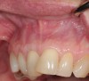 Fig 11. Cross-sectional view of the preoperative and postoperative (2 years). A three-dimensional increase of zone of keratinized and attached tissue is observed, restoring the lost attachment apparatus and correcting the gingival deformity in height and width.