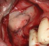 Fig 2. Lateral approach to sinus floor augmentation steps. Full-thickness flap elevated and the outline of the lateral window is marked.