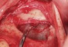 Fig 6. Dissection and isolation of a major blood vessel from the sinus wall during surgery.