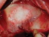 Fig 4. Space is created between the Schneiderian membrane and the sinus walls filled with particulate xenograft.