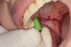 Fig 13. Crestal sinus floor augmentation using saline. Following crestal osteotomy preparation, hydraulic condensing pressure is carried out using a designated device for saline delivery. The device has a silicone end that enables sealing of the crestal preparation, preventing leakage of saline.