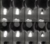 Fig 12. Cone-beam computed tomography 6 months after the procedure reveals the bony mantle covering the inserted implants.