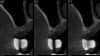 Fig 16. Sinus floor augmentation using the balloon technique. Cone-beam computed tomography of a missing upper first molar prior to sinus floor augmentation.