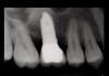 Fig 19. Peri-apical X-ray 13 months after sinus floor elevation and implant insertion.