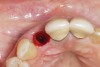 Fig 5. Atraumatic extraction without raising the flap, with the intention of minimizing bone loss, especially in the interproximal area.