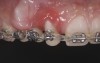 Fig 6. Eruption of tooth No. 6 to the apical third and tooth No. 8 beyond its alveolus was needed to achieve ideal site development. This degree of forced eruption often results in lingual displacement that needs to be managed with root-torquing auxiliaries. Sulcular epithelium eversion can be observed on tooth No. 8.