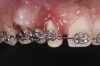 Fig 7. Eruption of tooth No. 6 to the apical third and tooth No. 8 beyond its alveolus was needed to achieve ideal site development. This degree of forced eruption often results in lingual displacement that needs to be managed with root-torquing auxiliaries. Sulcular epithelium eversion can be observed on tooth No. 8.