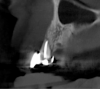 Fig 10. Tomographic images of teeth Nos. 6 (Fig 10), 7 (Fig 11), and 8 (Fig 12) clearly showed vertical gains in alveolar height, including in the edentulous area corresponding to tooth No. 7. The apex of tooth No. 8 was located within the soft tissue because it was force-erupted beyond its socket.