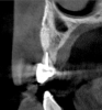 Fig 13. Flapless horizontal bone augmentation in the areas of teeth Nos. 6 (Fig 13), 7 (Fig 14), and 8 (Fig 15), using SMART method.