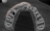 Fig 16. The SMART bone-graft procedure was extended to horizontally augment adjacent areas that exhibited dehiscences and thin buccal plates. This augmentation is clearly evident when compared with the preoperative condition shown in Fig 4.