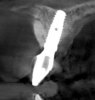 Fig 22. The implants selected for teeth Nos. 6 (Fig 22) and 8 (Fig 23) featured a tapered design.