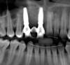 Fig 24. At 3 months post immediate implant placement and provisionalization, complete regeneration of the defect and adequate osseous crest 
levels and bone-to-implant contact were evident radiographically.