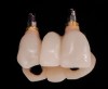 Fig 20. After extraction of teeth Nos. 6 and 8, implants were placed and a screw-retained immediate three-unit provisional was delivered.