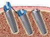 Fig 2. Supracrestal (left) versus subcrestal angular correction. Geometric correction of angulated abutment is transferred and included into the neck of the dual-axial fixture (arrow).