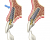 Fig 7. Uniaxial (left) versus dual-axial (right) implant fixtures in the anterior maxilla. A uniaxial fixture encroaches on/perforates the buccal plate (arrow), while a biaxial implant allows thicker buccal plate preservation and stability in the available palatal triangle of bone.