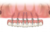 Fig 9. Dual-axial maxillary implant solutions to mitigate need for sinus augmentation and onlay grafts.