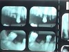 Fig 1. Radiographs showing an example of “meth mouth.”