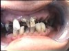 Fig 2. Gross oral destruction was the result of more than 20 years of meth use in this 41-year-old woman.