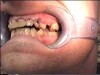 Fig 3. After 5 years of meth use in a 22-year-old male patient, cervical decay and coronal fractures were evident.