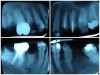 Fig 12. Radiographs of patient in Fig 10 and Fig 11 illustrating nonrestorability of the dentition.