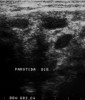 Fig 5. Sonogram in which the right parotid gland shows hypoechoic lesions giving the characteristic nodular pattern.