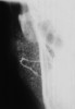 Fig 6. Sialogram showing a Christmas-tree pattern and uniform shape of the right parotid gland.