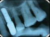 Fig 2. periapical radiographs.