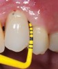 Fig 3. Peri-implant mucositis: mucosal inflammation.