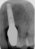 Fig 5. Radiograph showing no bone loss.