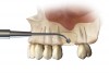 Fig 18. Illustration of SMART method. A full-thickness incision is made at a remote location, and a subperiosteal tunnel is developed to provide laparoscopic access to the site (Fig 17). A subperiosteal pouch is then created to confine the graft without damaging the periosteum (Fig 18).