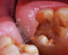 A 9-year-old presented with hypoplasia, hypocalcification, and caries.