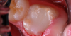 Images of the repaired molar immediately after restoration